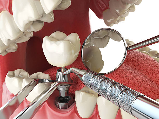 Best Emergency Tooth Extraction in Southaven, MS